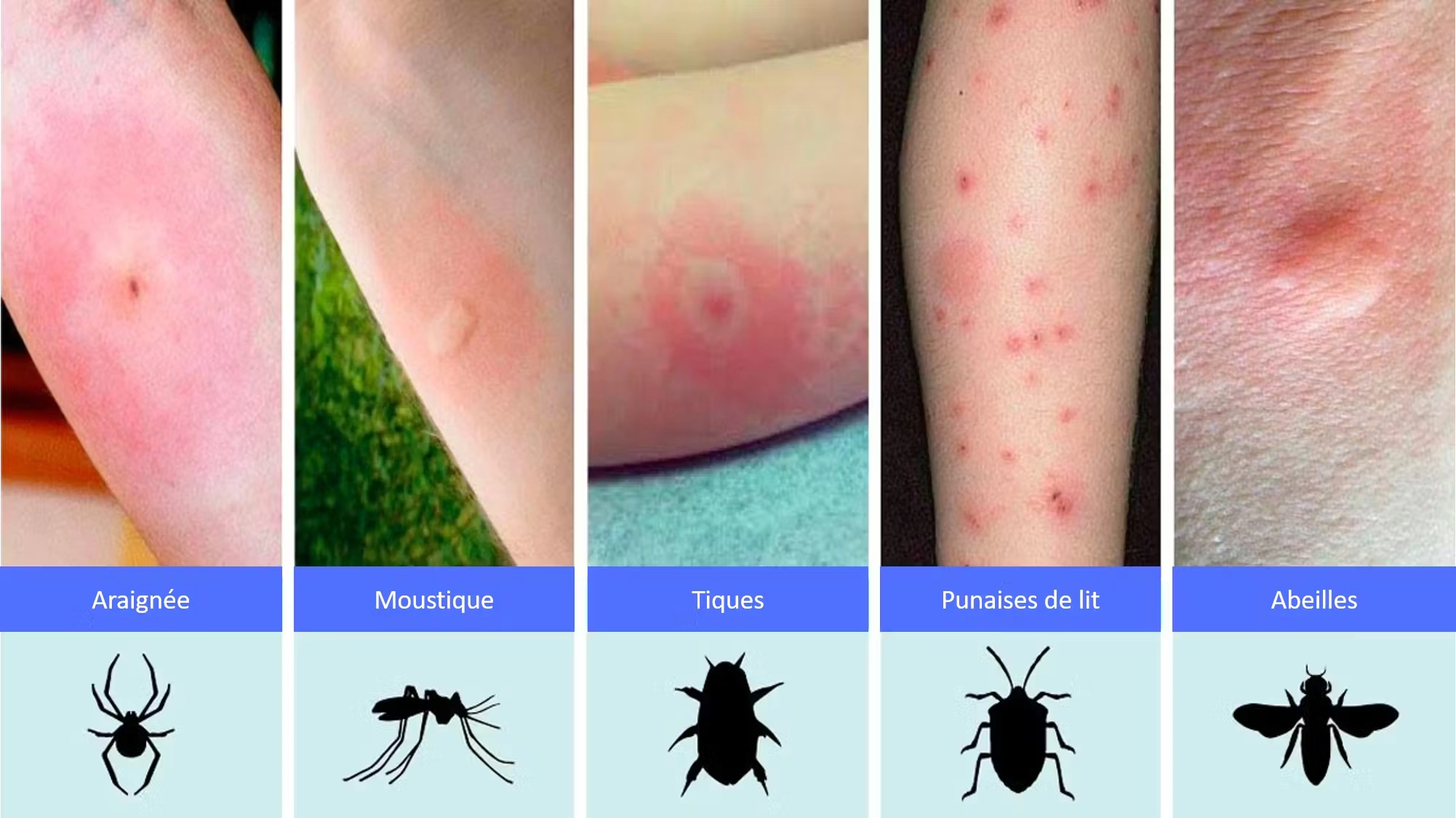 Comparatif de cinq piqûres sur la peau : araignée, moustique, tique, punaise de lit et abeille